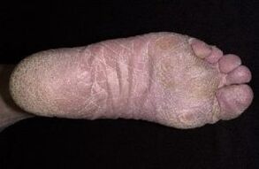 Anzeichen und Symptome von Pilzen an den Beinen