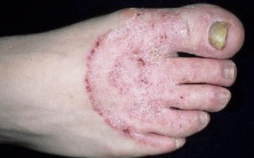 Die Gründe für das Aussehen des Pilzes an den Beinen