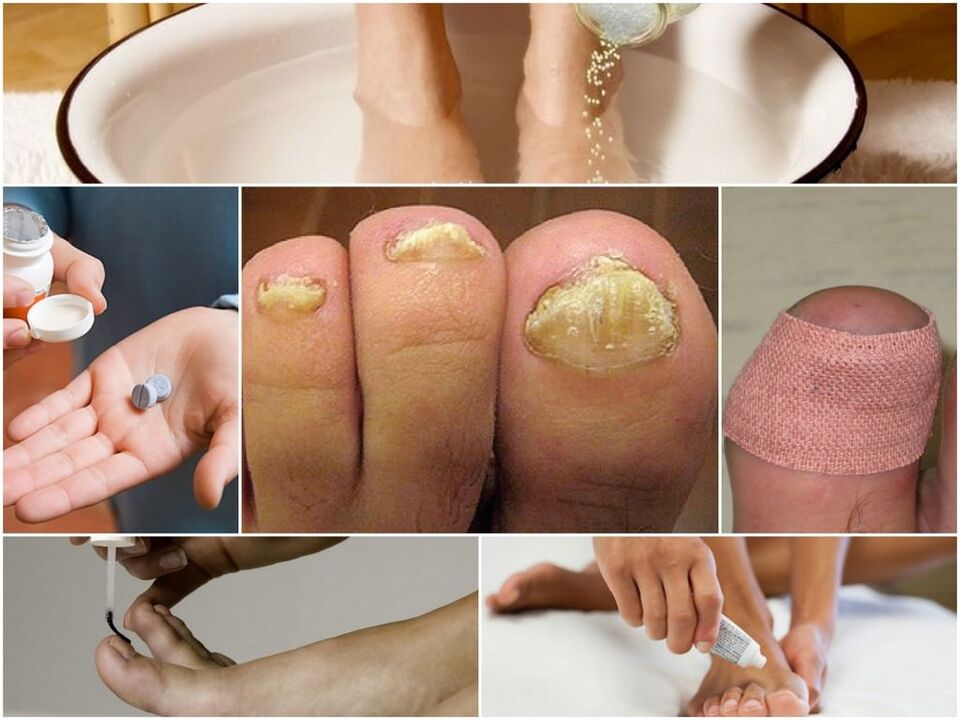 Behandlung des Nagelpilzes