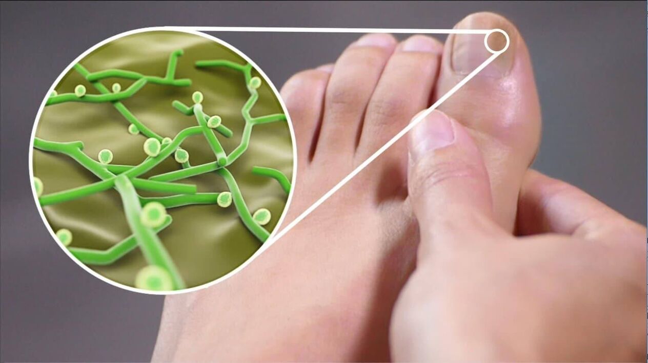 Erreger von Zehennagelpilz