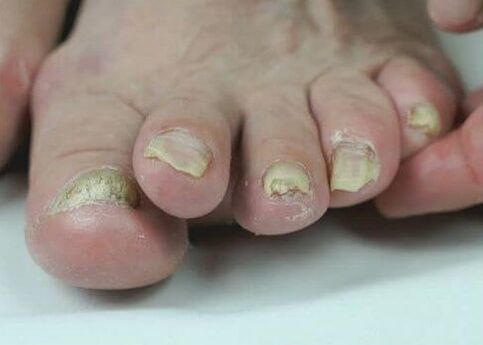 Nagelpilzbehandlung mit Medikamenten