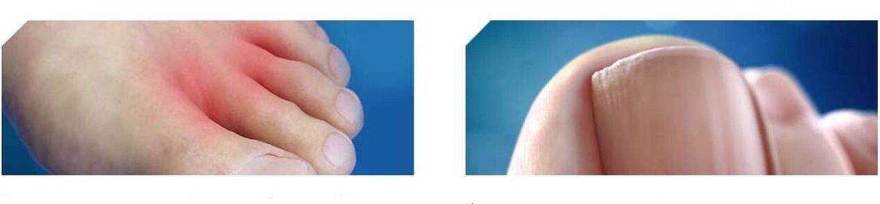 Anfangsstadium eines Fußpilzes