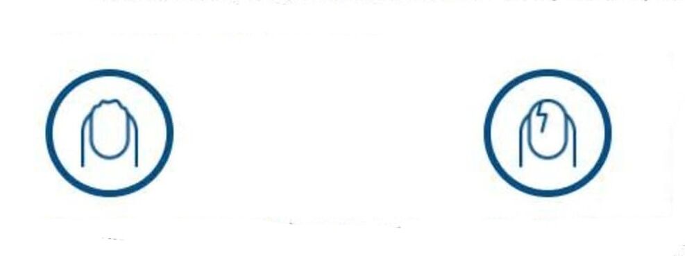 Nagelverformung aufgrund einer Pilzinfektion